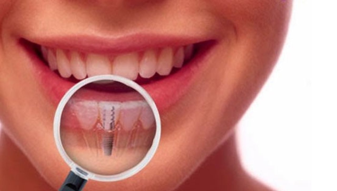 Você sabe o que é um Implante Dentário?