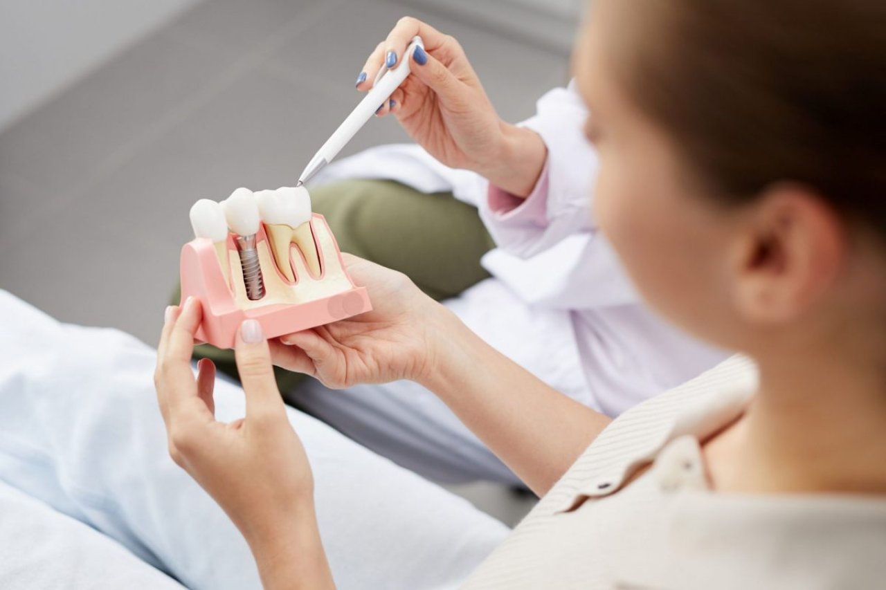 Perguntas frequentes sobre implantes dentário