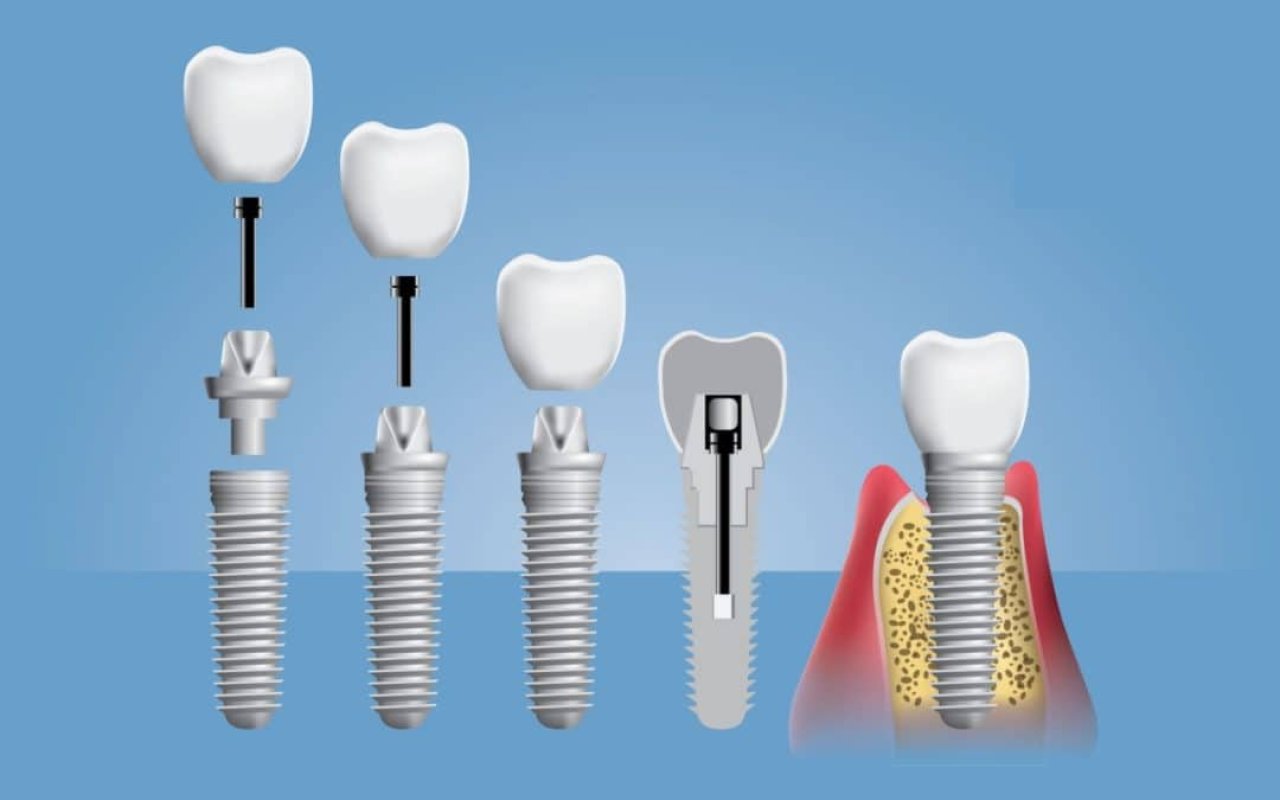 Quais são os tipos de implante dentário?