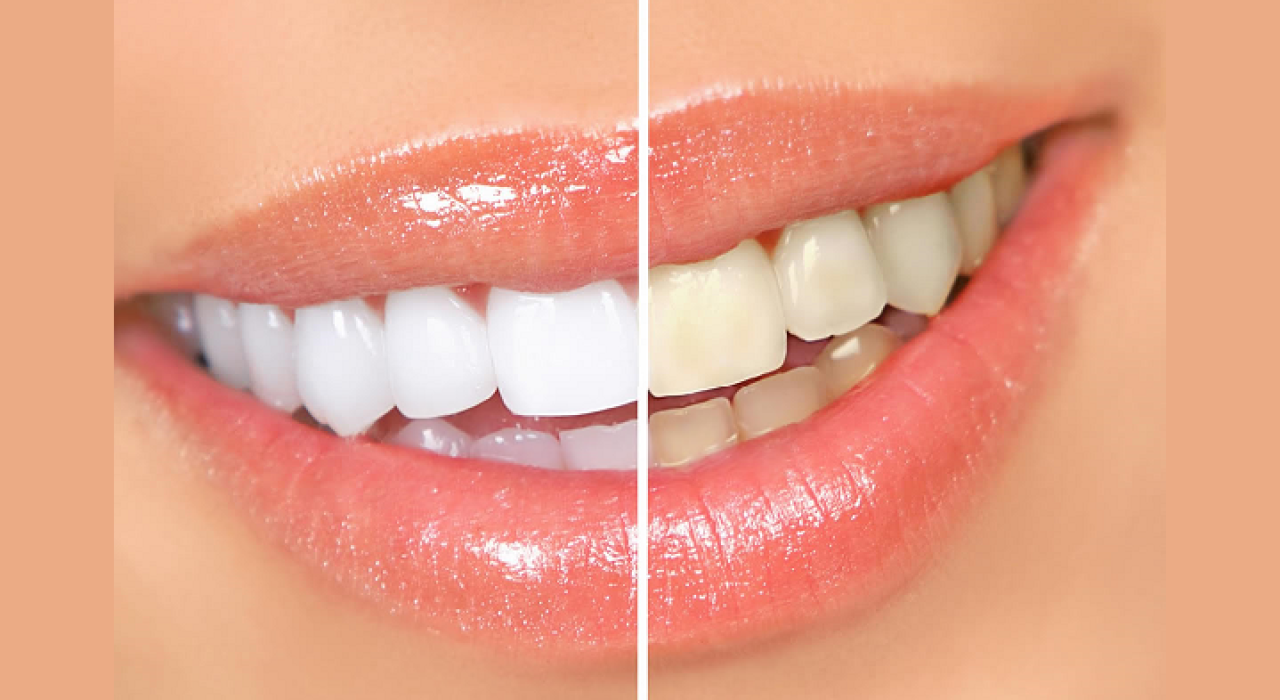 Clareamento Dental em Salvador