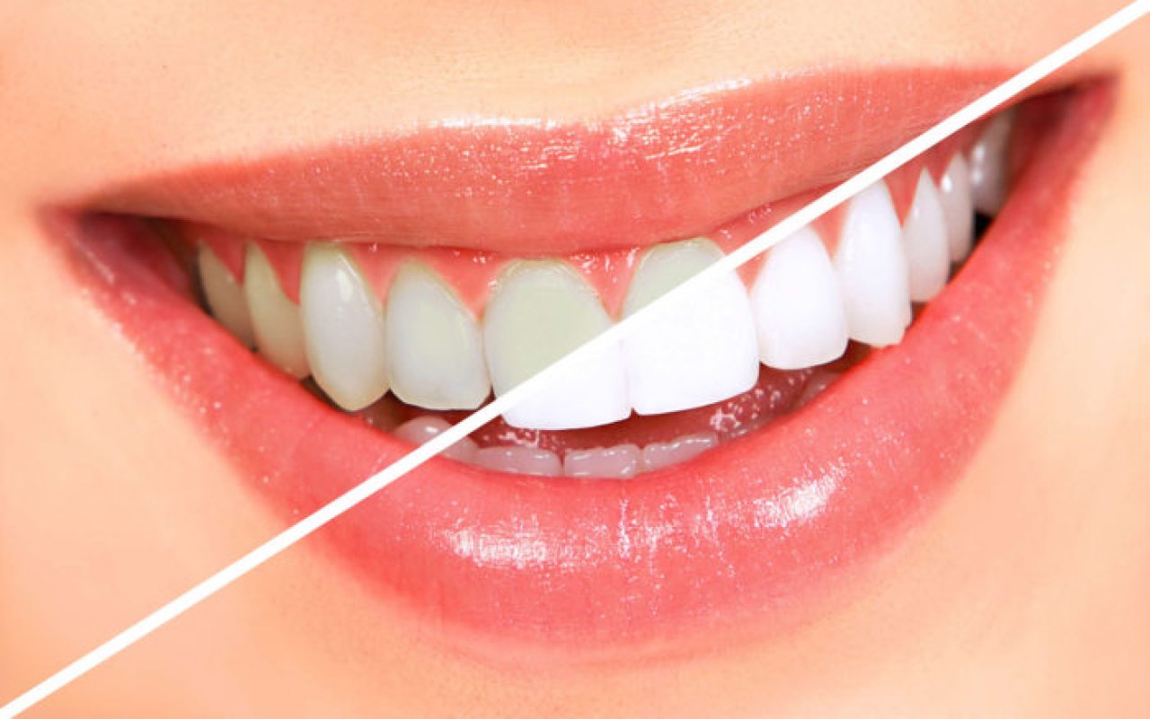 Um Sorriso Mais Brilhante: O Que Você Precisa Saber Sobre Clareamento Dental
