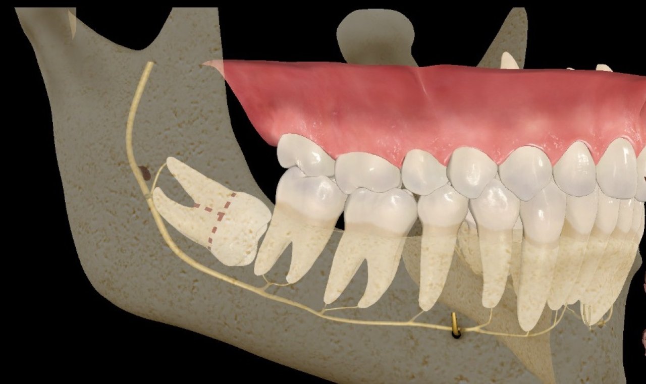 Cirurgias de dentes inclusos - Dentista Salvador