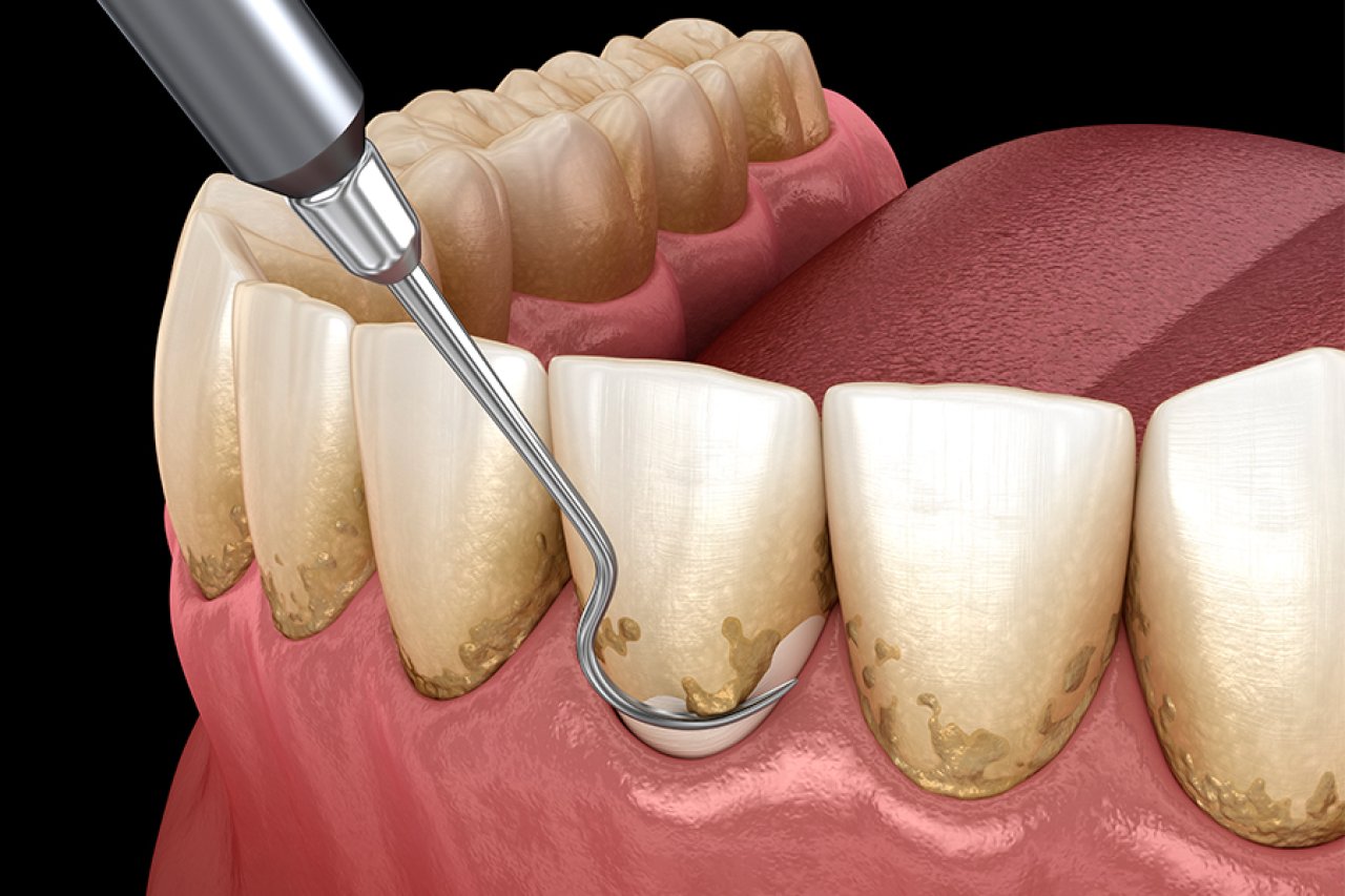 Periodontia - Dentista Salvador